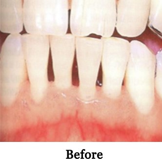 Gingival-Grafts- before