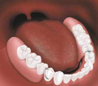 Partial Dentures after