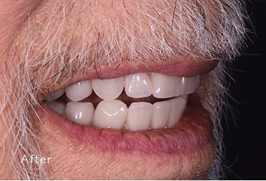 Upper-and-Lower-Denture-Before-and-After_en after