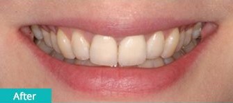 single-tooth-implant after