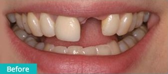 single-tooth-implant before
