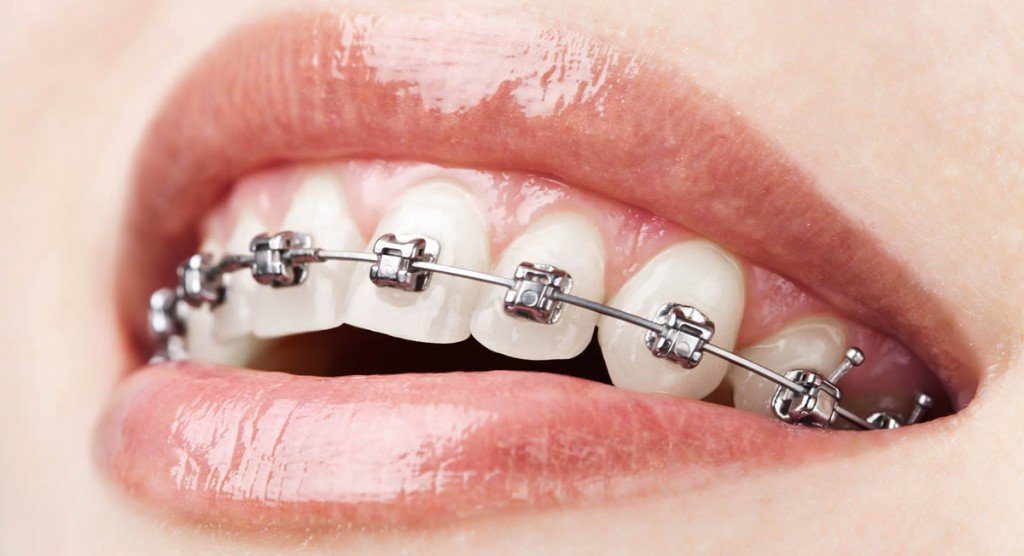 understanding-metal-braces