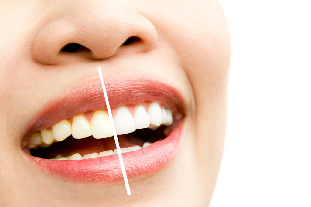 Teeth Whitening Or Bleaching